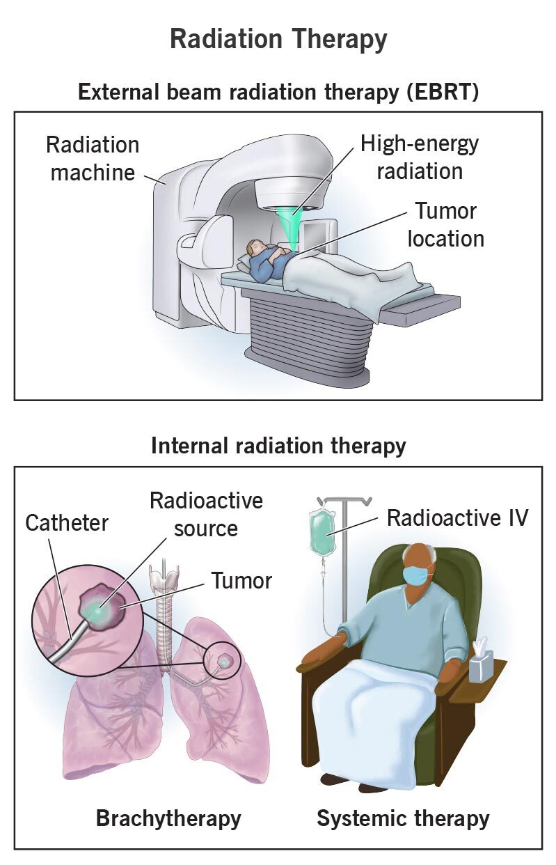 Radiation Therapy