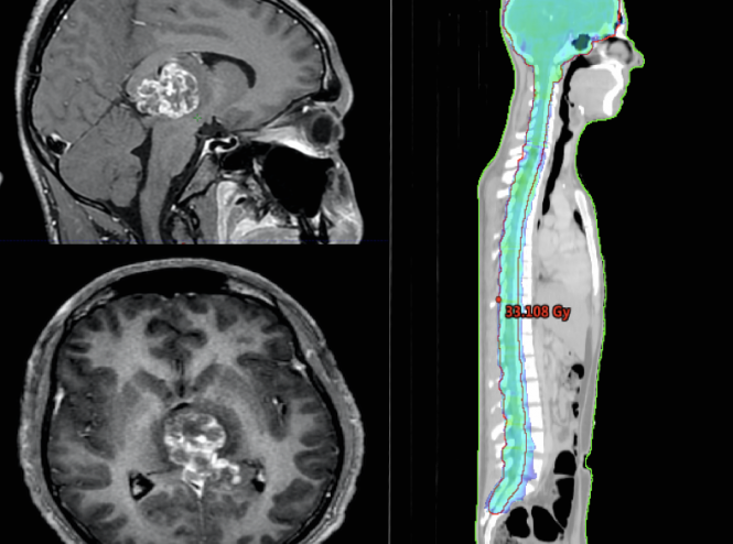 cranio-spinal