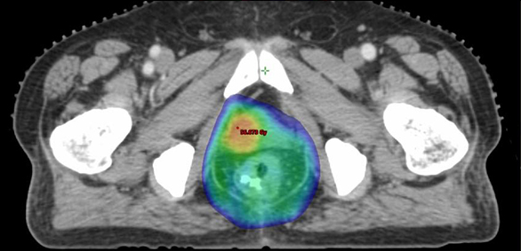 gi-series-synchronous-rectal-and-prostate-cancer-2-1