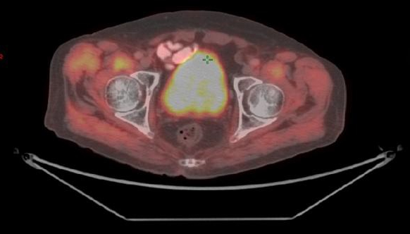 gi-series-synchronous-rectal-and-prostate-cancer-3