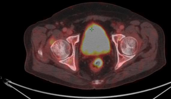 gi-series-synchronous-rectal-and-prostate-cancer-4