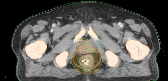 gi-series-synchronous-rectal-and-prostate-cancer